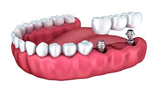 Catonsville Implant Dentist